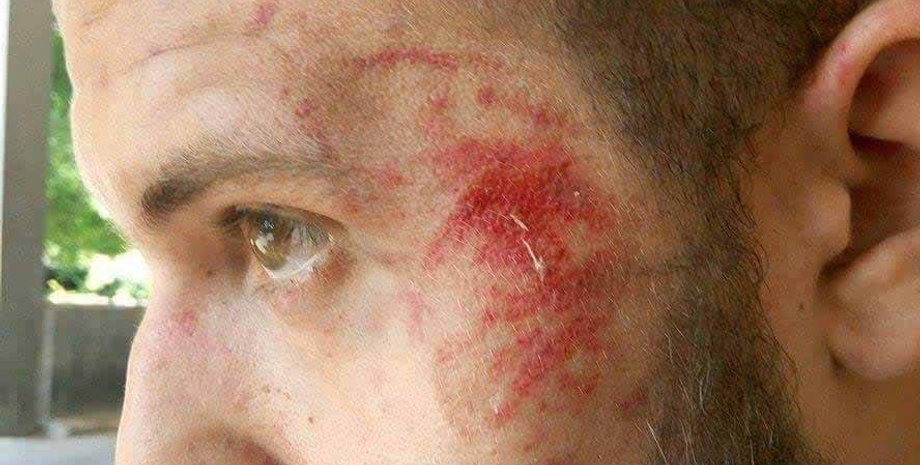 Журналиста "Громадське ТВ Запорожье" Анатолия Остапенко избили неизвестные / Фото: hromadske-zp.tv