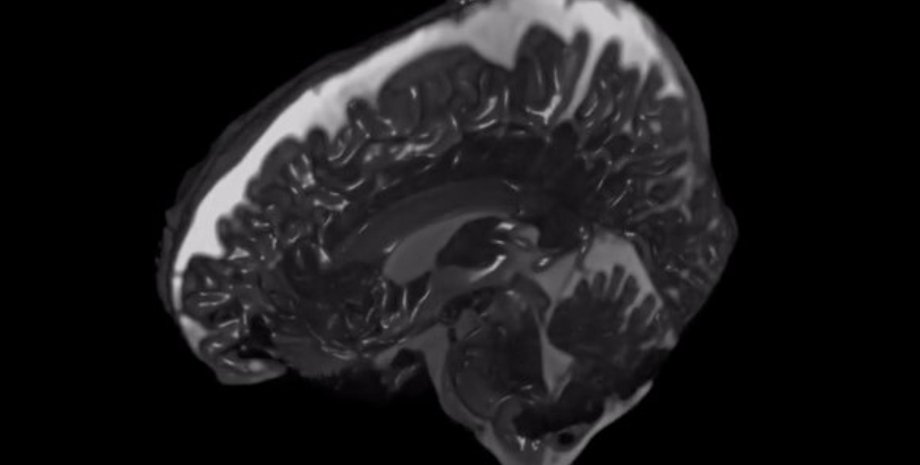 мозок МРТ