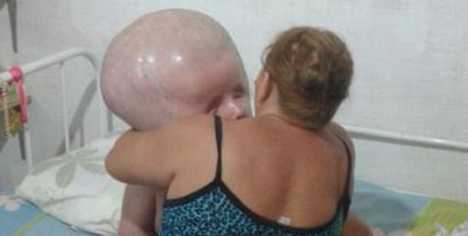 Женщина с большой головой, редкая болезнь, выглядит как младенец, болезнь, огромная голова,