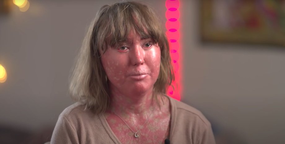 Наталі Ріхерт поскаржилась на булінг через рідкісне захворювання шкіри і про те, як вона з цим впоралась