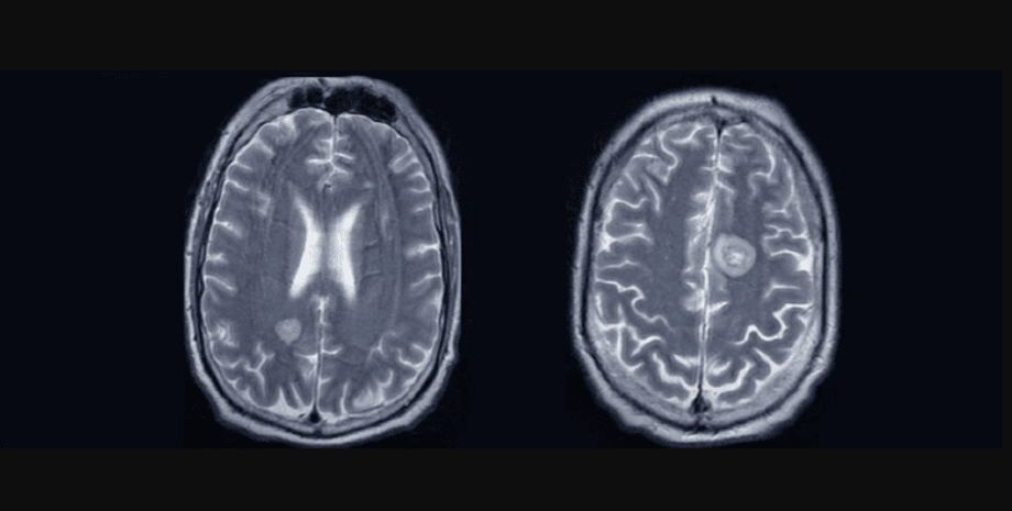 мрт мозга с раком