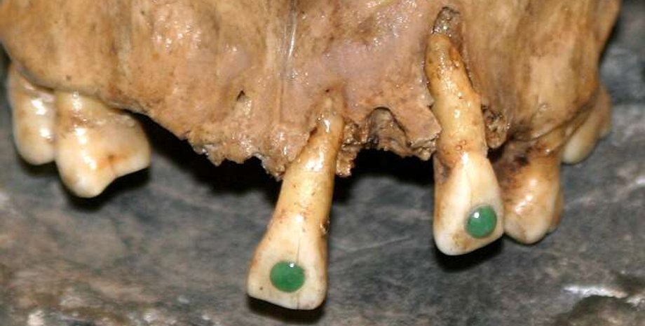 зуби, пломби, дорогоцінне каміння, фото