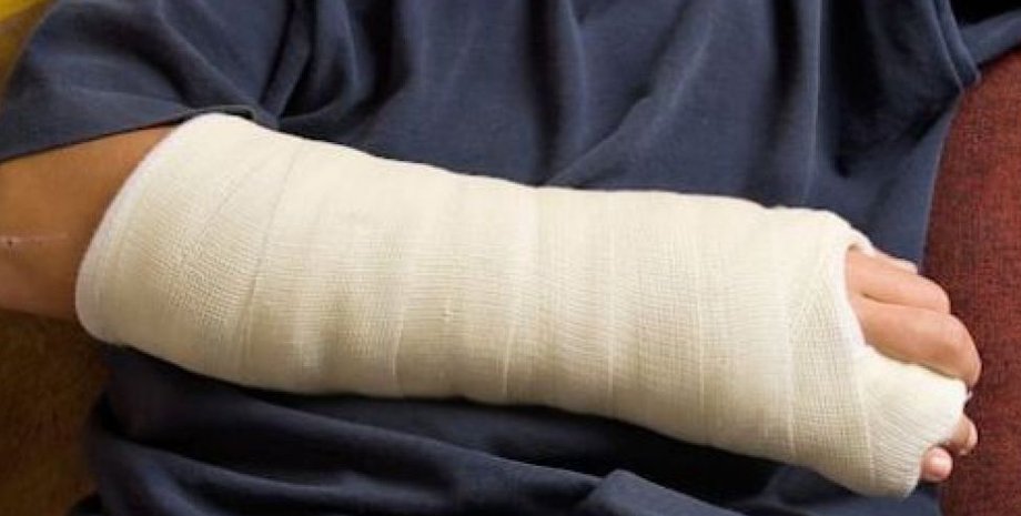 рука, гипс, перелом
