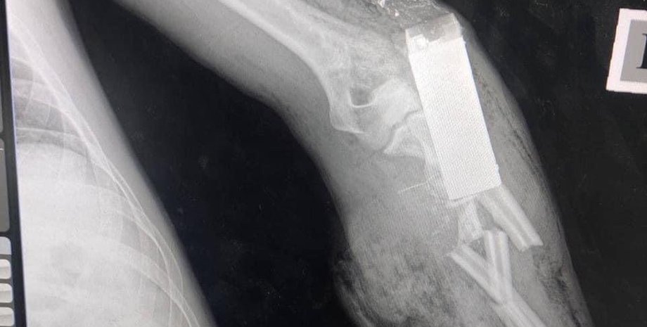 граната, ранение, рука, военный