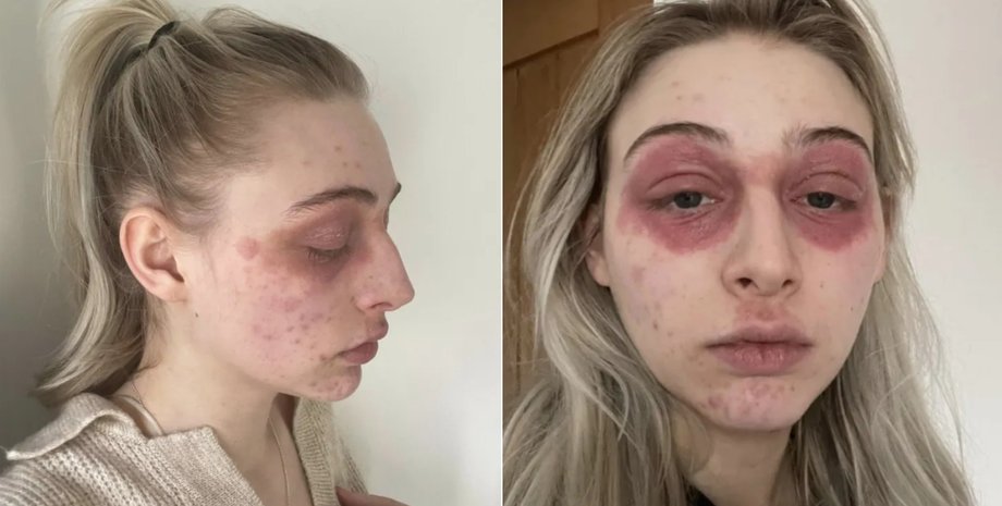 Харли Ватсон, аллергия, раздражение кожи на лице