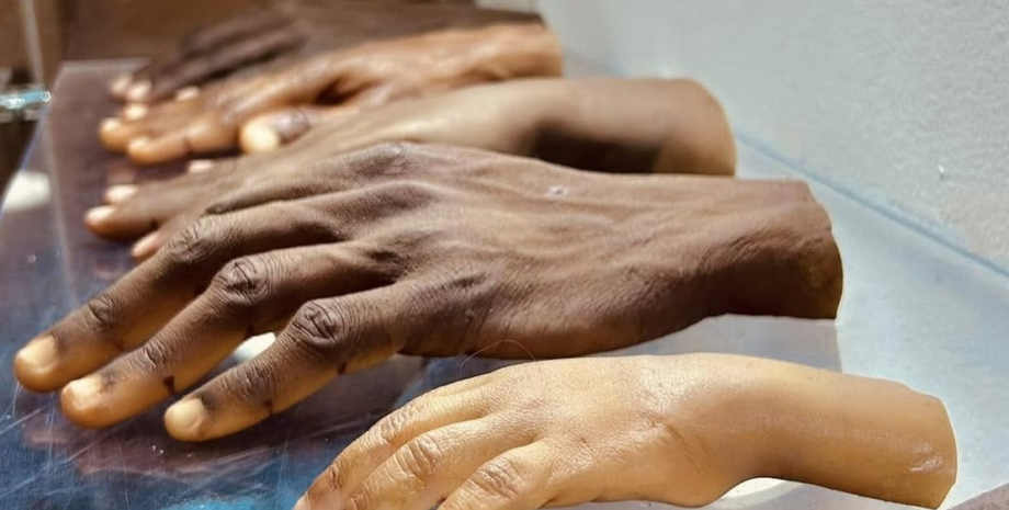 протезы, протезирование, изготовление протезов