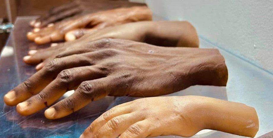 протези, протезування, виготовлення протезів