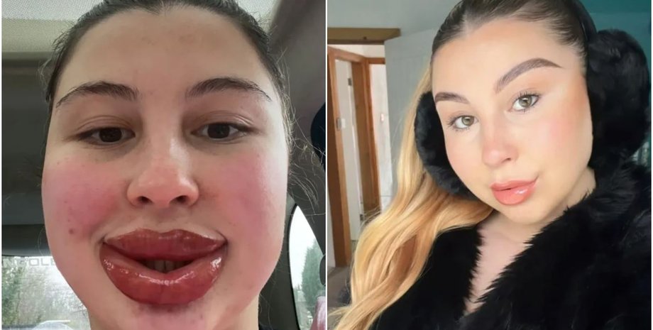 Женщина решила увеличить губы в салоне красоты, но процедура пошла не по плану, курьезы, внешность