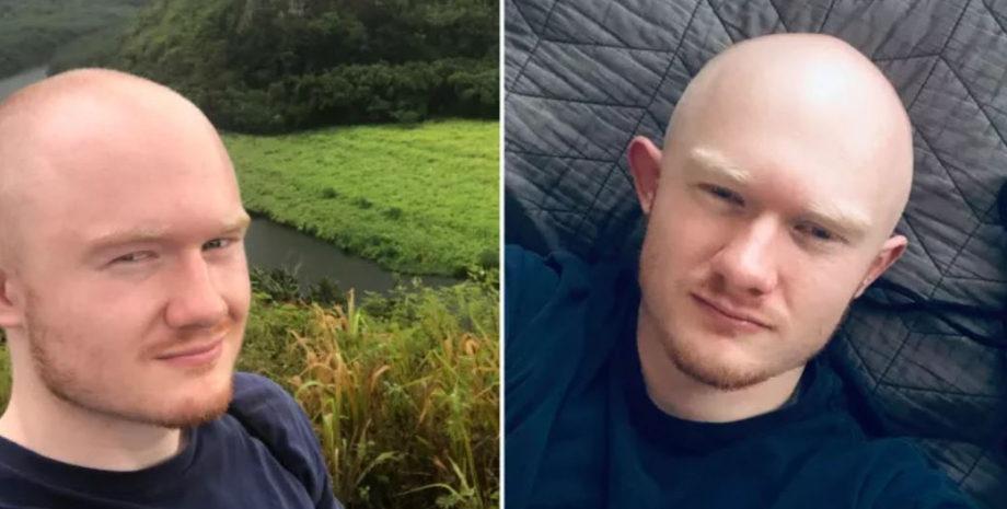 Облысение у мужчин до и после, потеря волос в молодом возрасте, какой выход из ситуации, опыт мужчины