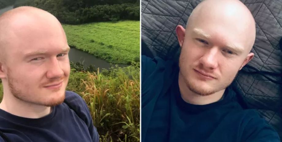 Облысение у мужчин до и после, потеря волос в молодом возрасте, какой выход из ситуации, опыт мужчины