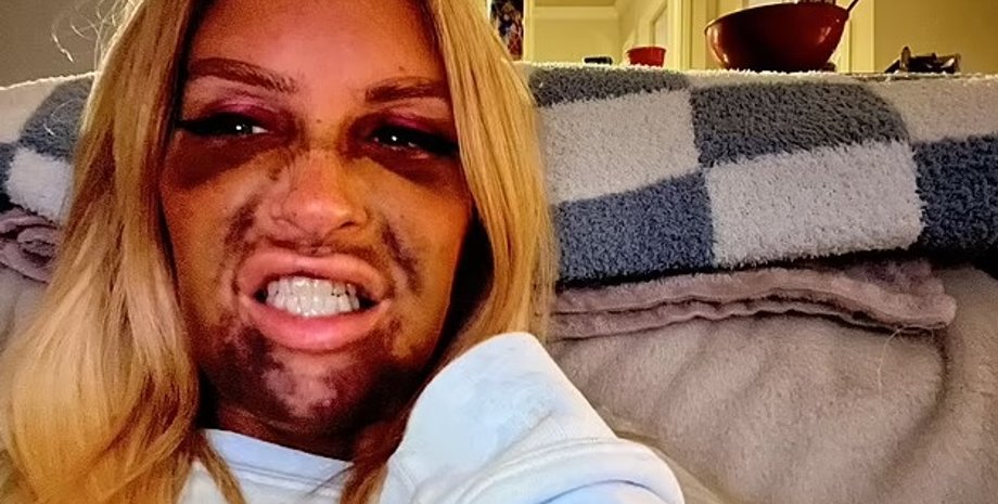 Джессіка Мако, імплантація зубів, протезування, проблеми з імплантацією