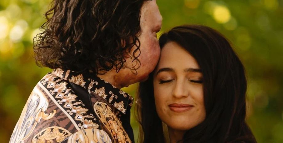 Джо ДиМео из США, которому пересадили лицо и руки, нашел свою любовь и вскоре женится