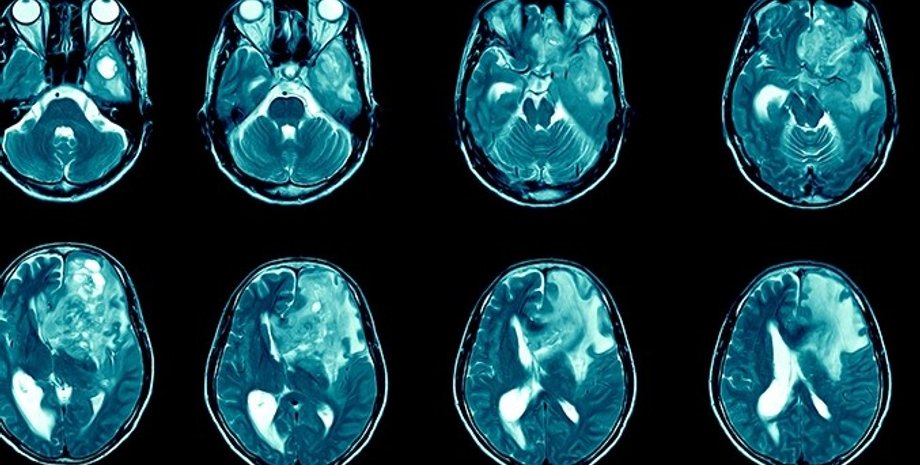 рак мозку, мозок, гліобластома