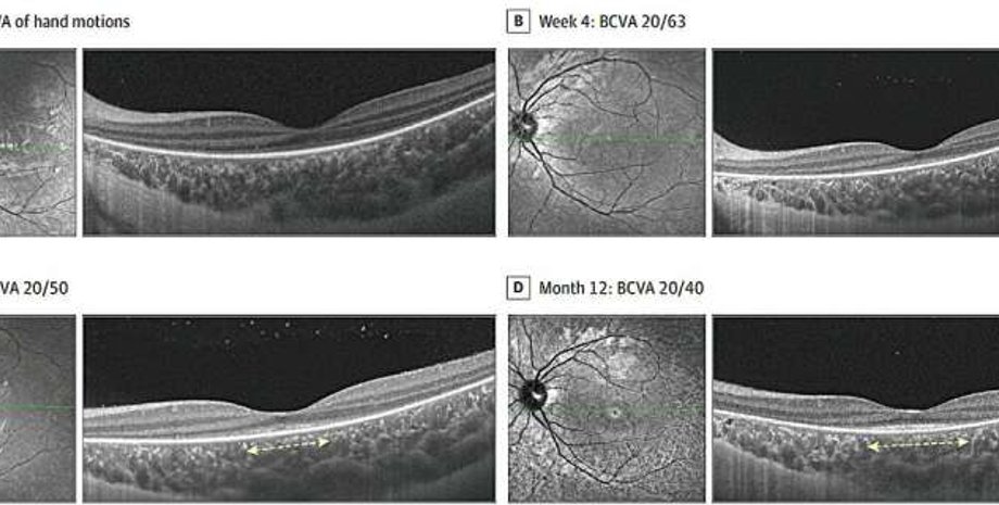 фоторецепторы, глаза, зрение, потеря зрения, дети, болезнь, Китай, заболевания, сетчатка, HORD, лечение, дисфункция, отклонения, воспаление