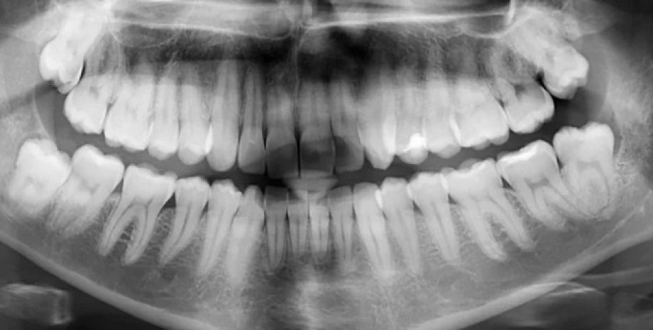 Рентгеновский снимок зубы
