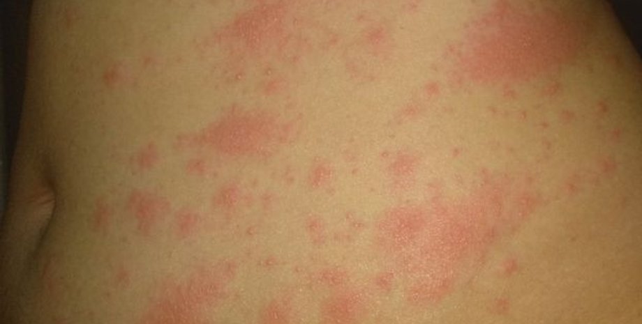Макулопаппилярная сыпь во время COVID-19. Фото: COVID-PIEL STUDY