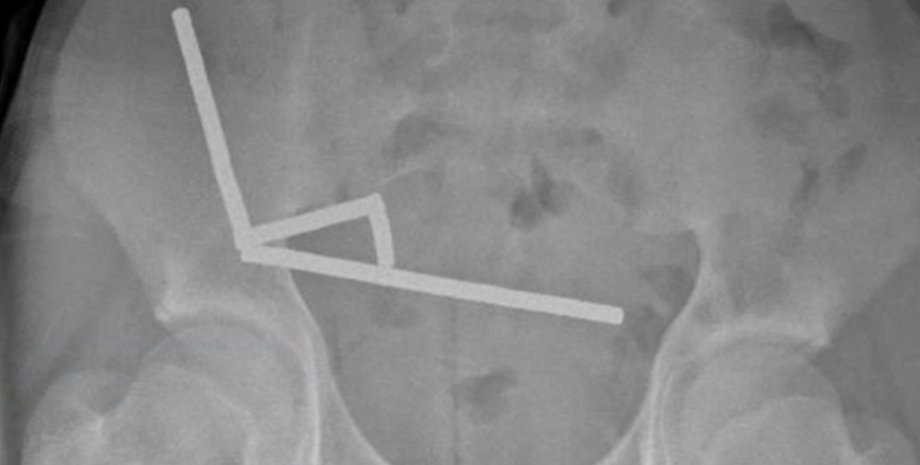 магниты в кишечнике