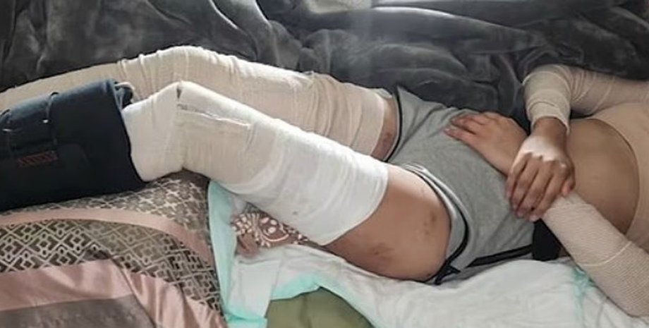 Собаки несколько раз укусили жертву за ноги и руки