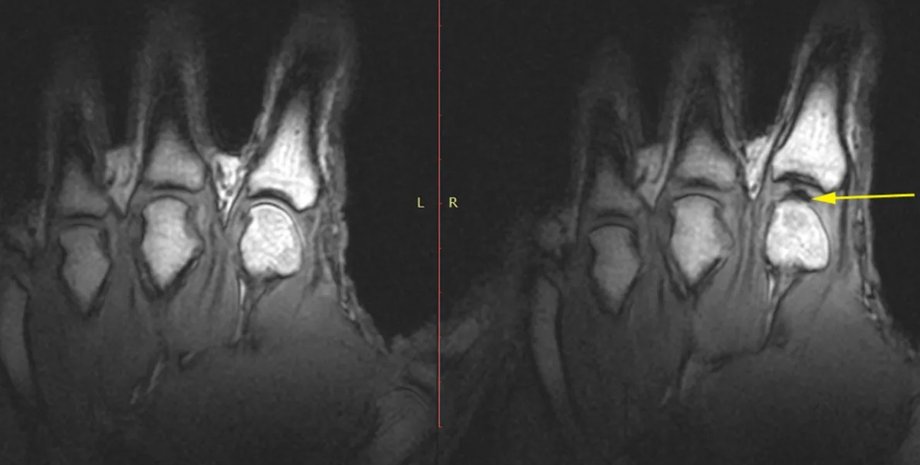 суставы, пальцы