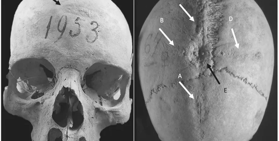 исследование, история, операция на череп, средневековье