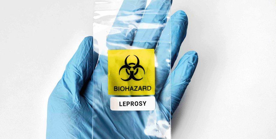 Проказа виявлена в Румунії Проказа