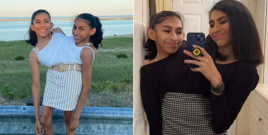 Сіамські близнючки Кармен та Люпіта Андраде, як вони живуть, зовнішність, аномалії, мутації, стосунки, історії цікавих людей, фото