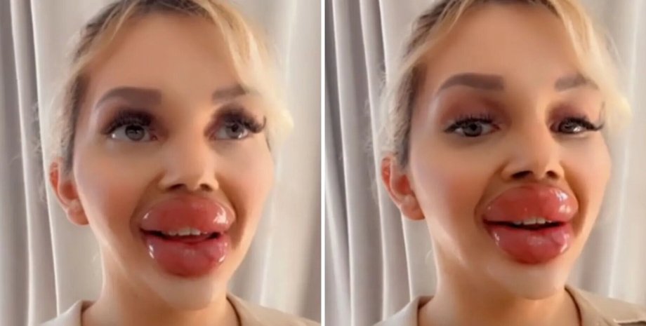 пластика, увеличение губ, самые большие губы, процедура, виена вюрзтель