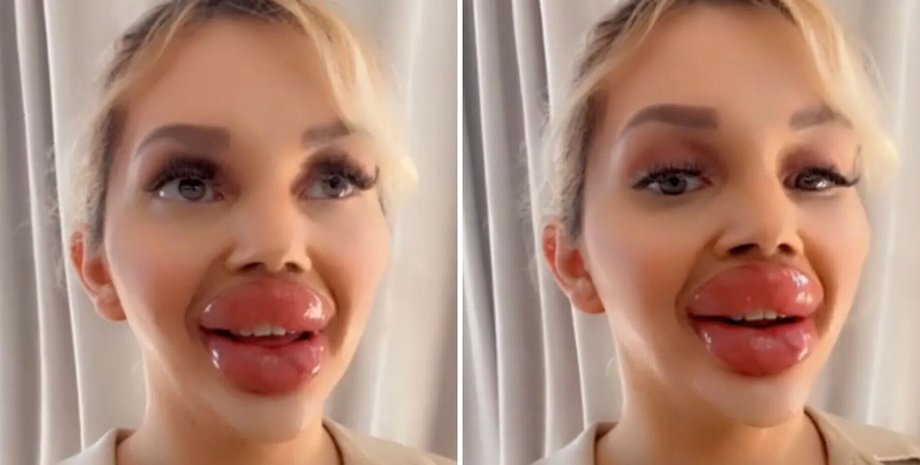 пластика, увеличение губ, самые большие губы, процедура, виена вюрстель