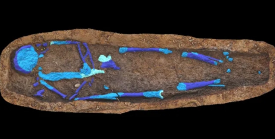 фарфоровый желчный пузырь фарфоровый желчный пузырь