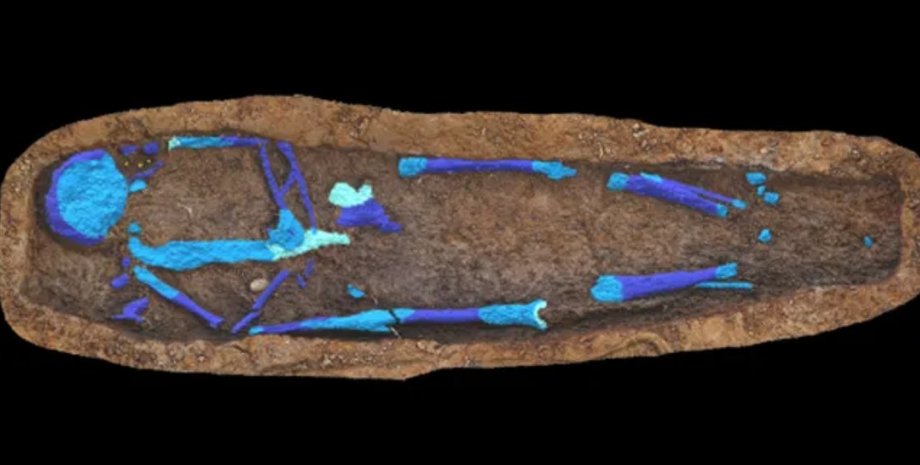 фарфоровый желчный пузырь