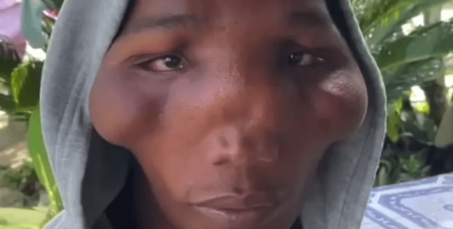 Семья, в которой дети болеет редким заболеванием, загадочные симптомы, редкая болезнь, деформация лица, проблемы со здоровьем