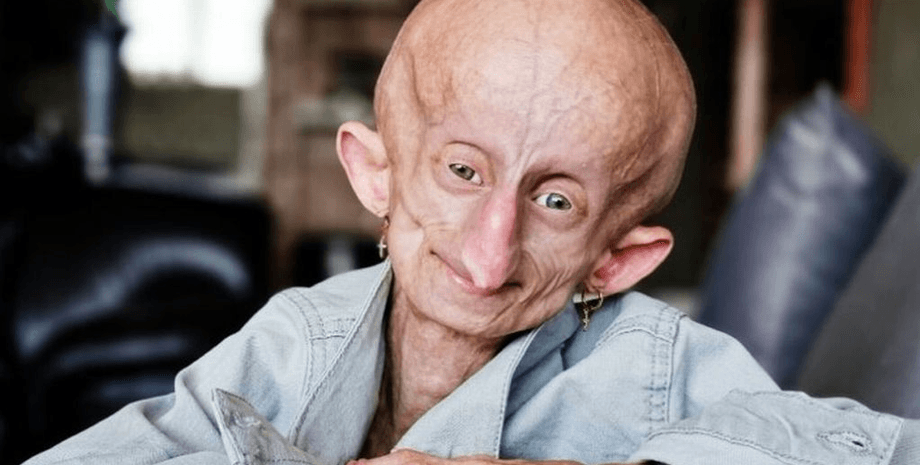 Девочка с редким заболеванием, Беандри Буйсен, редкий синдром, девушка старела в восемь раз быстрее, синдромом Хатчинсона-Гилфорда