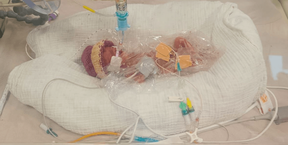 дитина, Уельс, Велика Британія, новонароджений, крихітна дитина, унікальний випадок