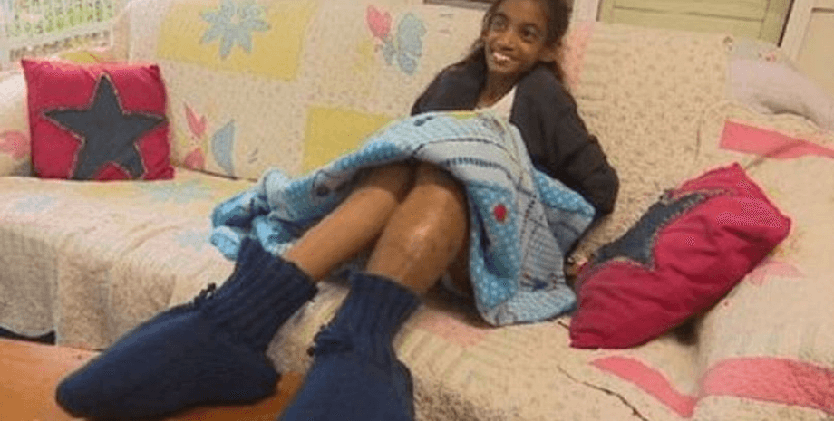 Дівчинка з великими ногами, рідкісна хвороба, хвороба, синдром, синдром гвоздики, альтернативне лікування, ампутація, великі ноги