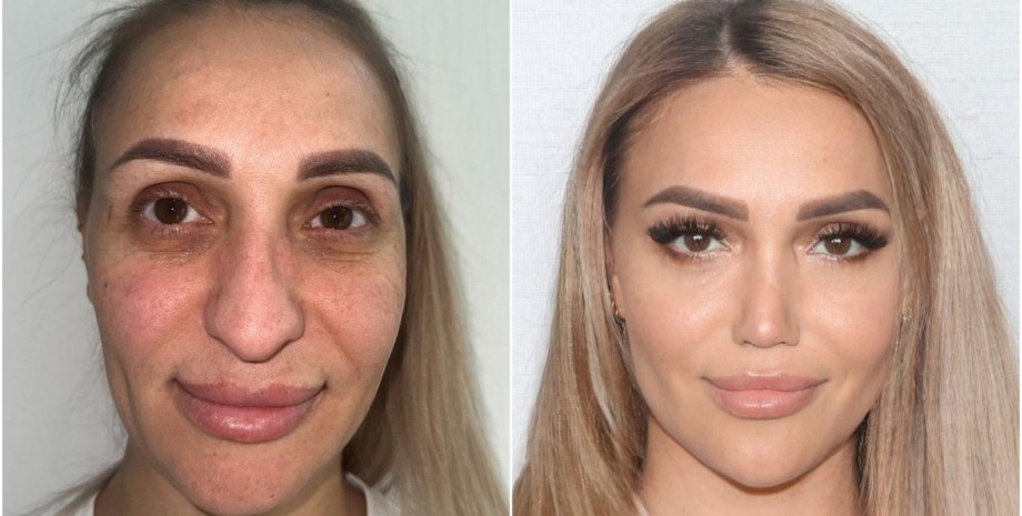 Женщину после пластической операции невозможно узнать, кардинальные изменения во внешности, фото до и после пластики