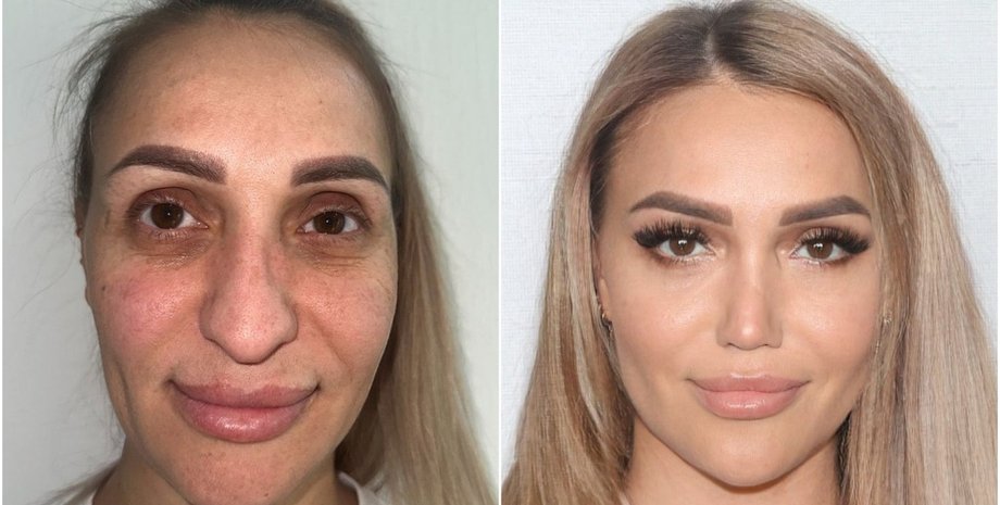 Женщину после пластической операции невозможно узнать, кардинальные изменения во внешности, фото до и после пластики