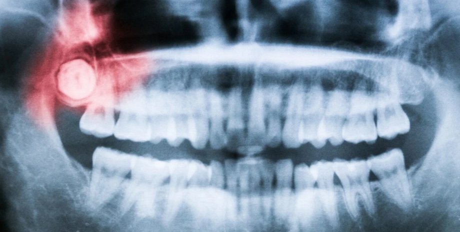 Зубы, челюсть, рентген