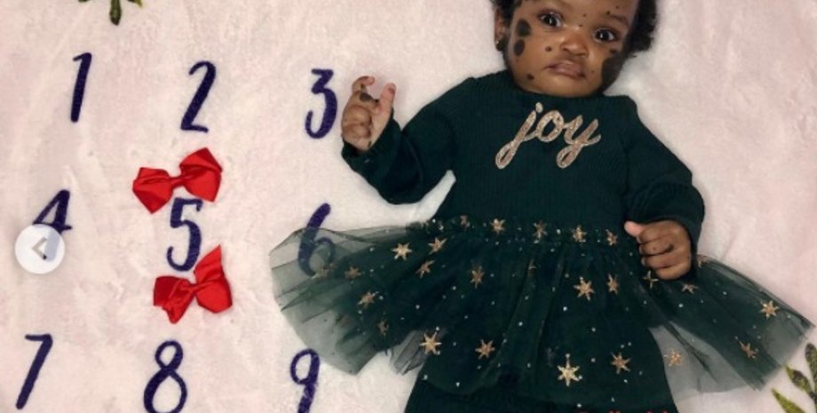 врожденный меланоцитарный невус, пятна на лице, редкое заболевание