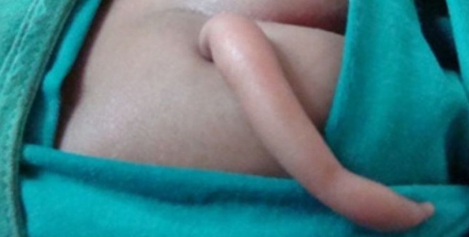 рудиментарный хвост, настоящий хвост, ребенок с хвостом