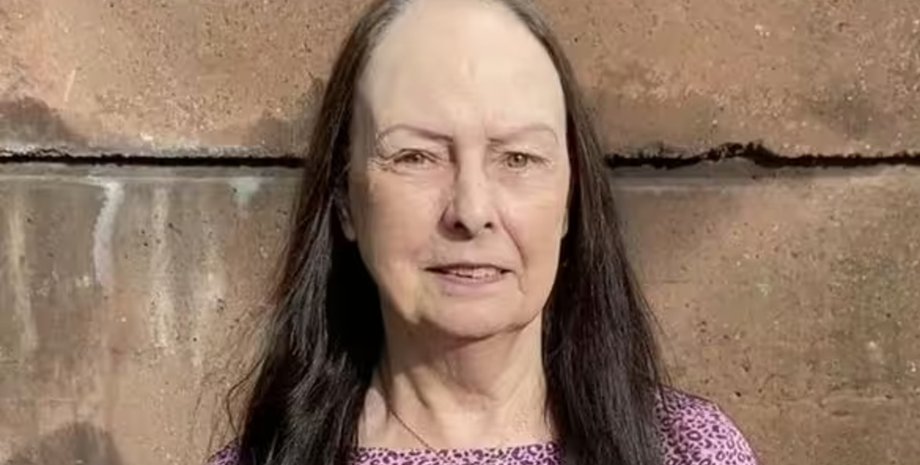 Женщина, волосы, пересадка волос, прическа, выпадение волос,