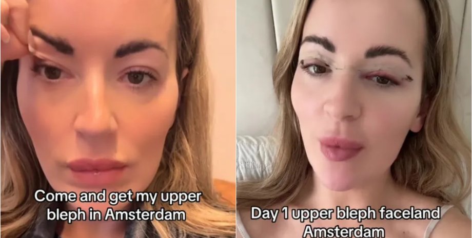 Жительница Великобритании сделала косметическую процедуру на опущенных веках, как она выглядит теперь