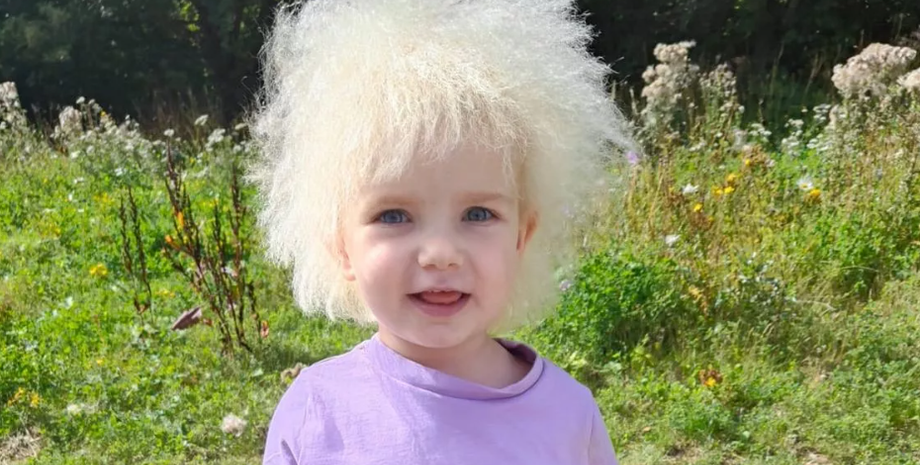 Синдром нерозчесаного волосся, діагноз, захворювання, діти, Велика Британія, фото, аномалії