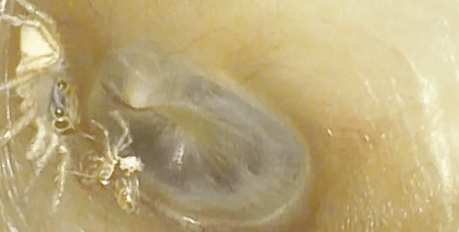 Паук в ухе женщины, ушной канал, паук в ухе, паук в ухе пенсионерки, достали паука из уха, шуршащие звуки, сбросил кожу