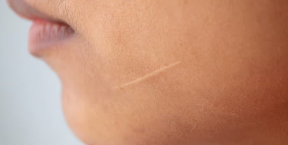 шрамы, рубцы