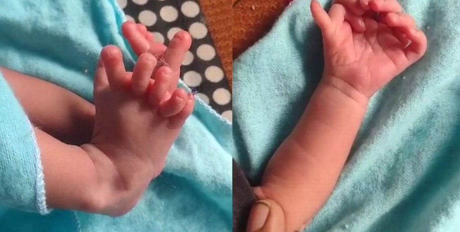 Девочка родилась с 26 пальцами, генетическая аномалия, редкое заболевание, реинкарнация богини, полидактилия