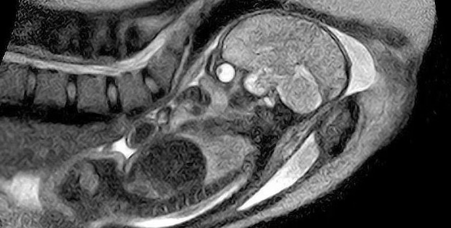 дитина, мрт скан, мрт скан плоду