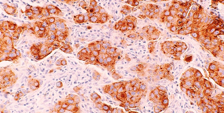 неоплазма рак, клетки, микроскоп