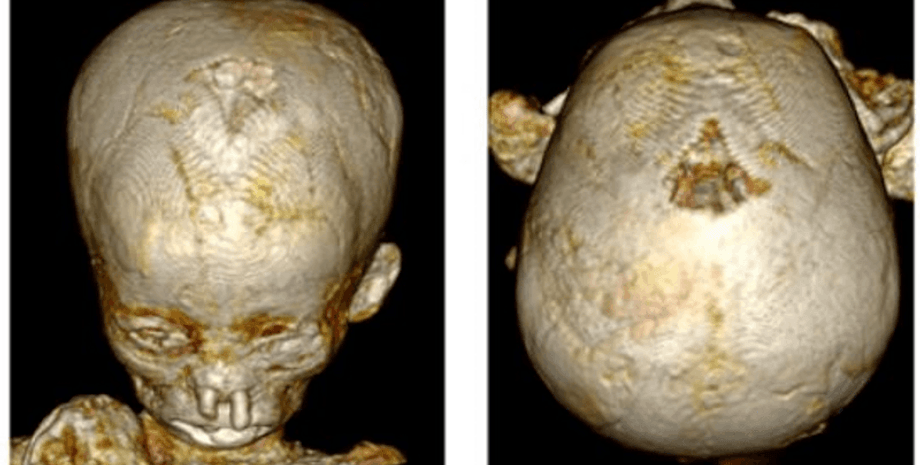 исследование, история, мумия, древний египет, древние египтяне, смертельное заболевание, смертельная болезнь, анемия, малярия