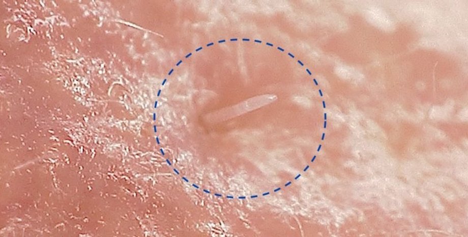 клещ, кожный клещ