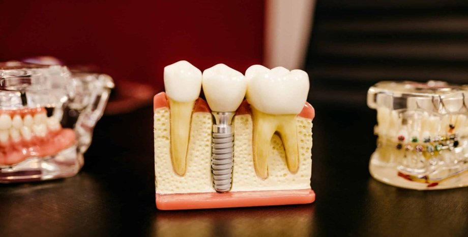 зубы, лечение зубов